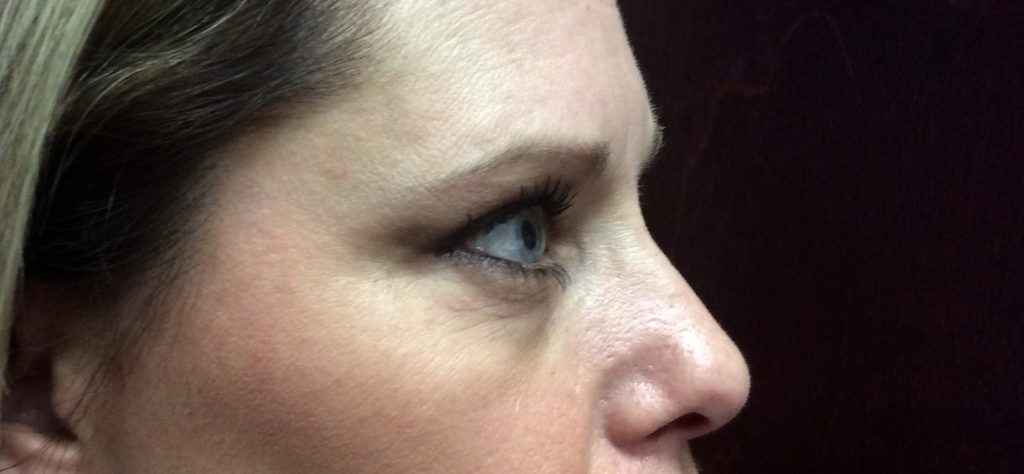 ultherapy upper face (eyes and Brow) after-1