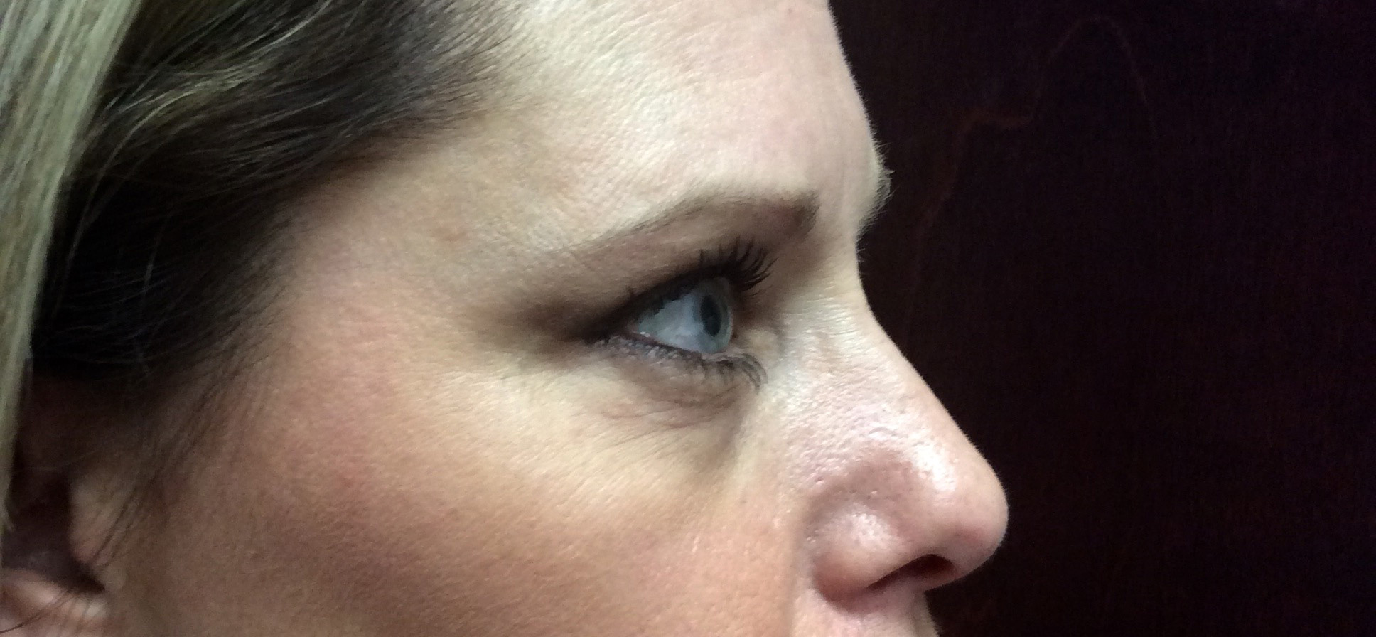 ultherapy upper face (eyes and Brow) after-1