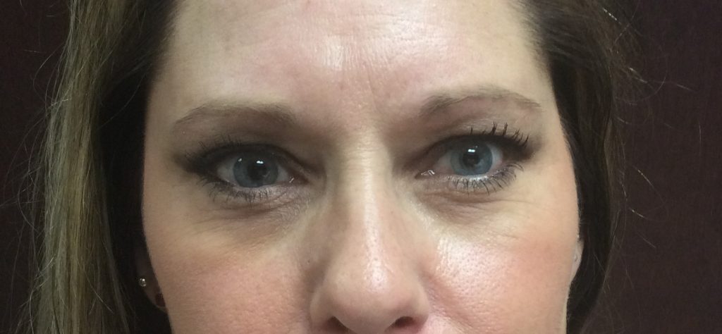 ultherapy upper face (eyes and Brow) after-2
