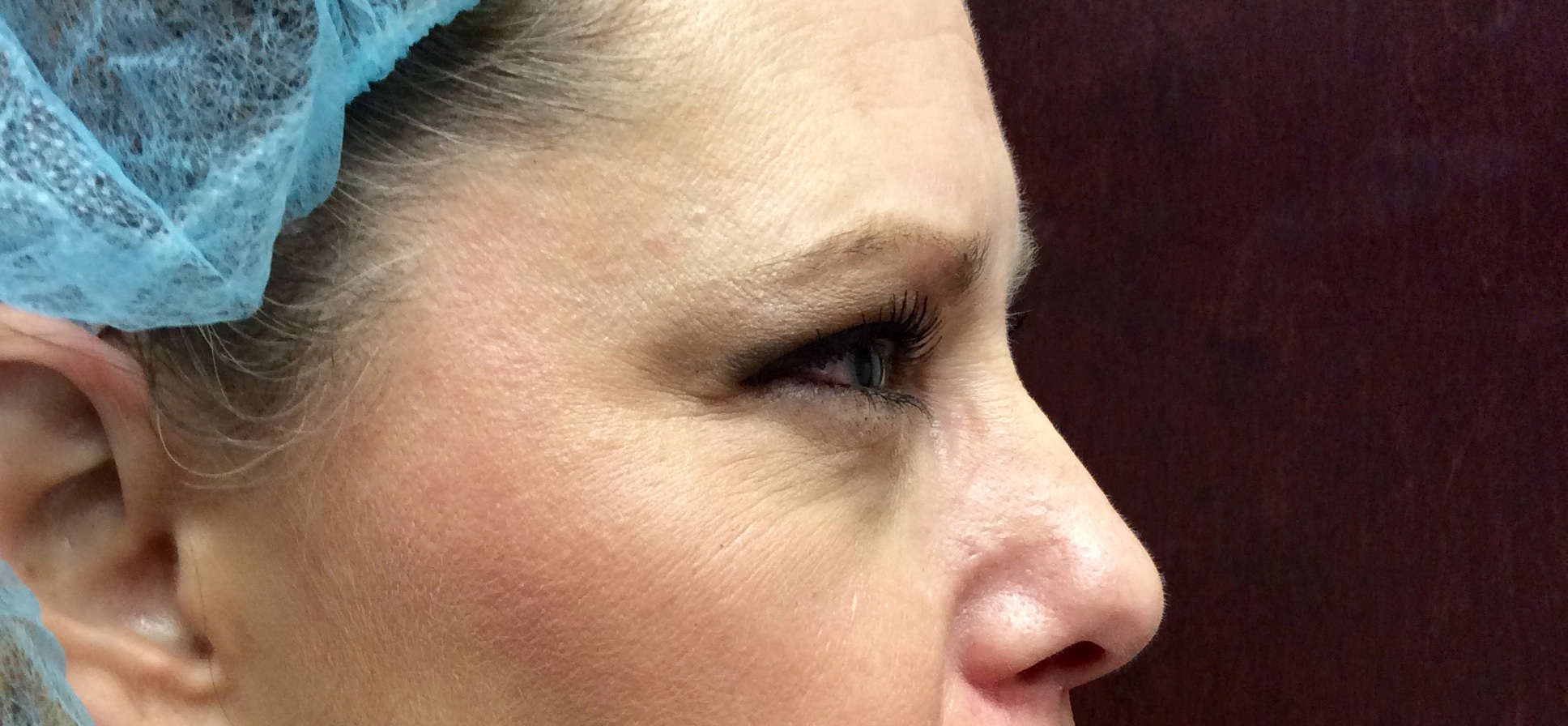 ultherapy upper face (eyes and Brow) before1