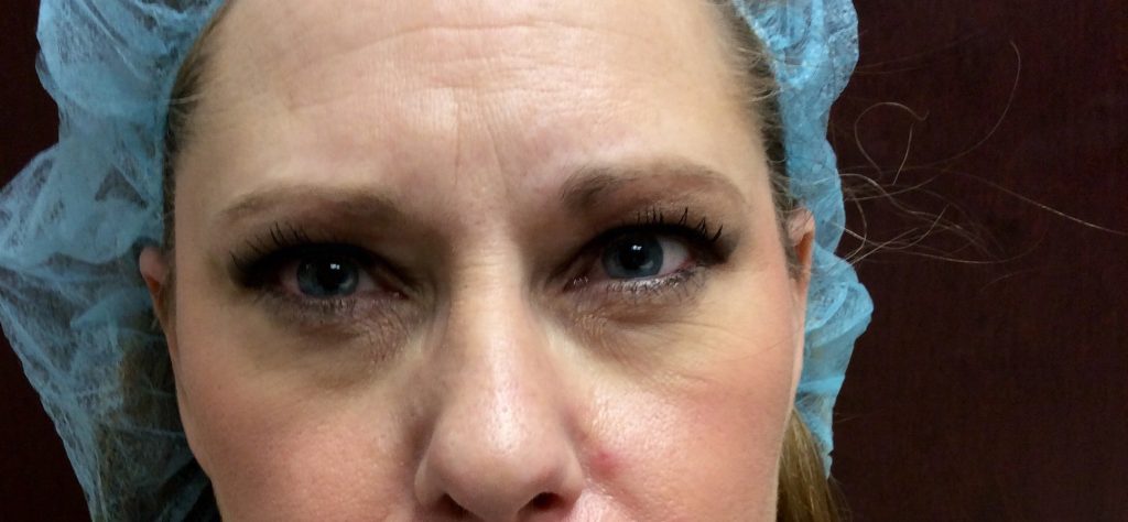 ultherapy upper face (eyes and Brow) before2