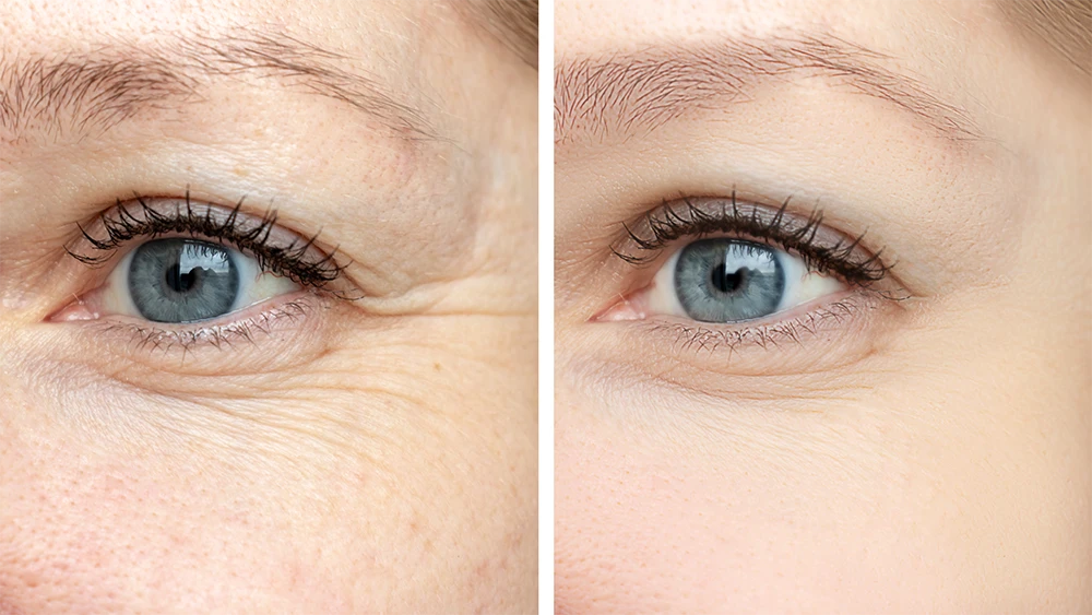 A thoughtful treatment plan also considers how one area relates to another. Treating a single line without considering the surrounding anatomy can produce a result that does not look balanced.
