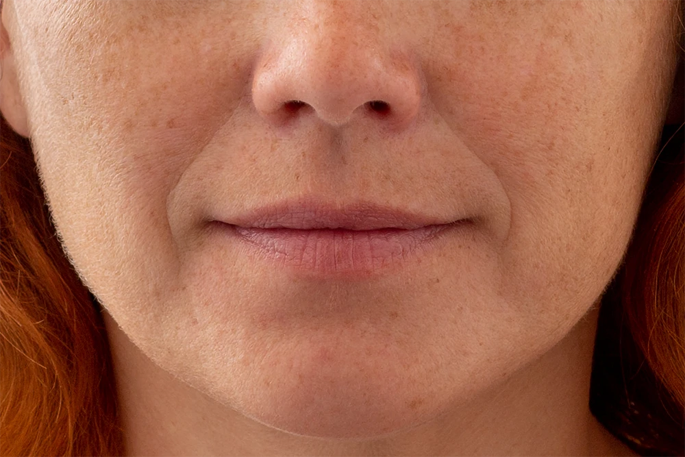 JUVÉDERM Ultra XC and Ultra Plus XC are indicated for moderate to severe facial wrinkles and folds, including nasolabial folds